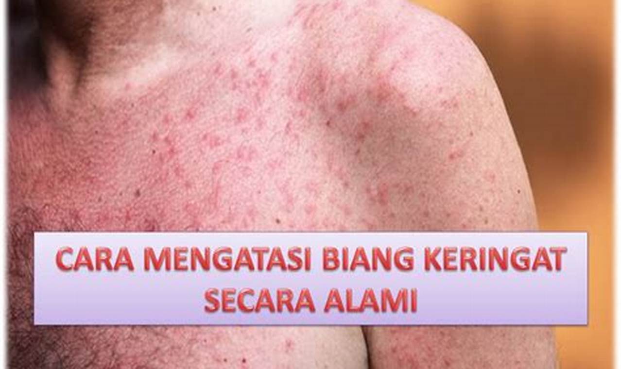 cara mengatasi biang keringat